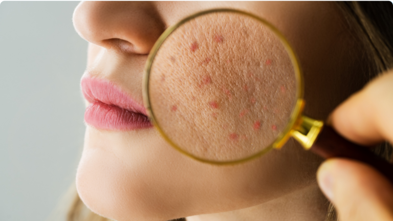 Lire la suite à propos de l’article Soleil et peau acnéique : comment prendre soin de sa peau ?